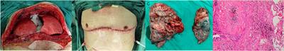 Bilateral Lung Transplantation for Patients With Destroyed Lung and Asymmetric Chest Deformity
